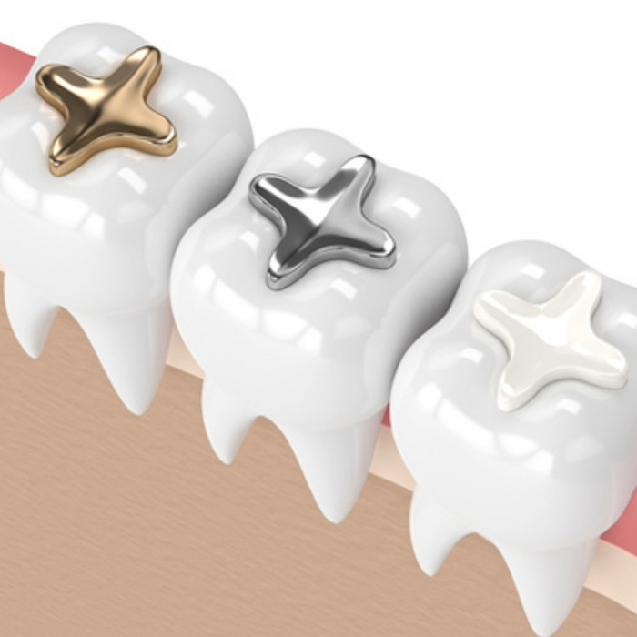 Tooth-Colored Fillings (Composite Fillings)