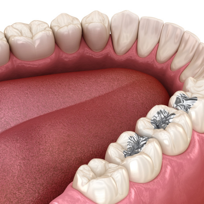 Sealants for Cavity Prevention