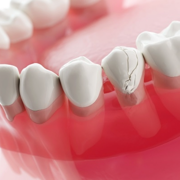 Chipped Tooth Repair