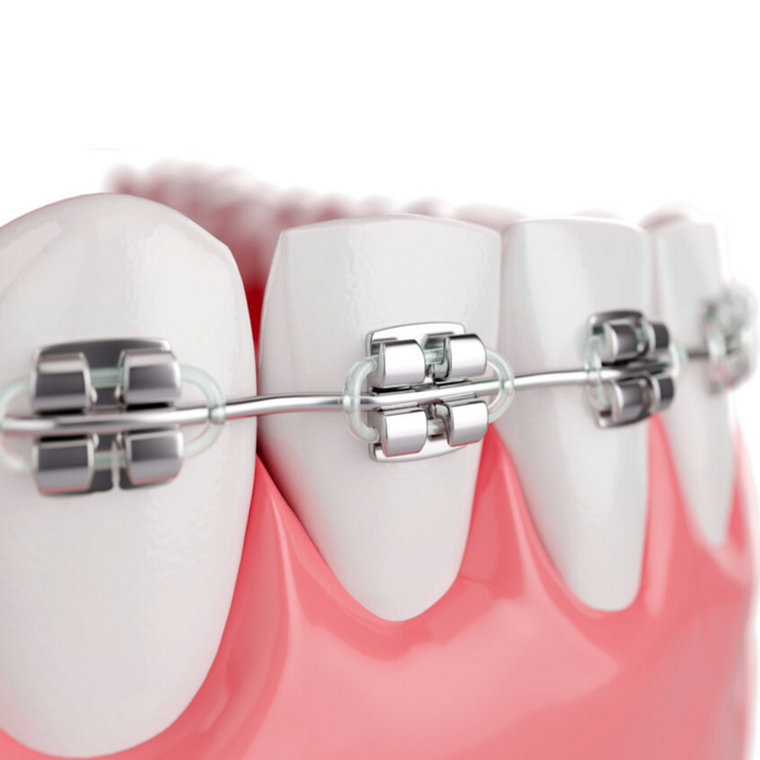 Metal Braces
