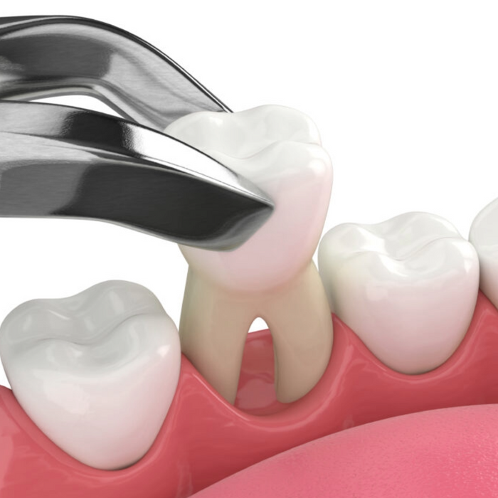 Extractions (Tooth Removal)