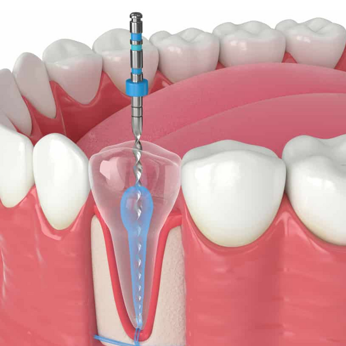 Pulpotomy (Baby Root Canal)