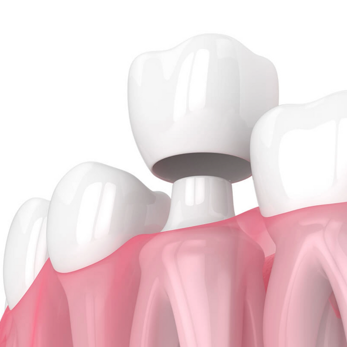 Dental Crowns