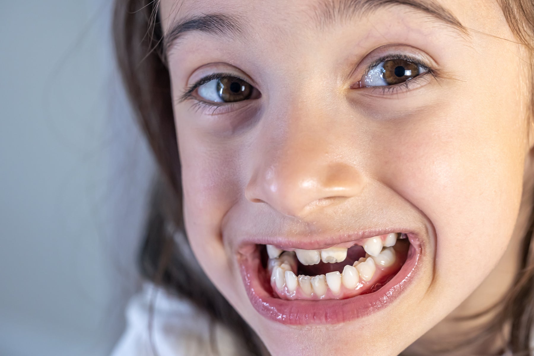 Child's Permanent Teeth Coming In Discolored