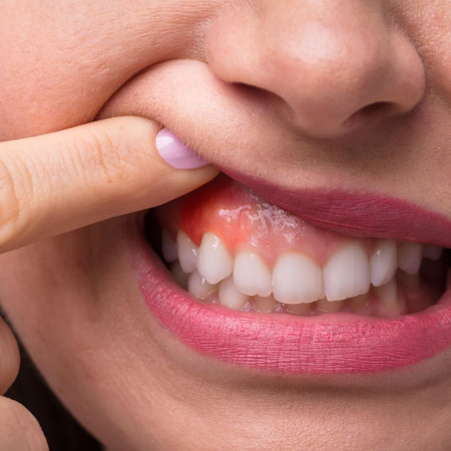 Fastest Way to Heal Swollen Gums