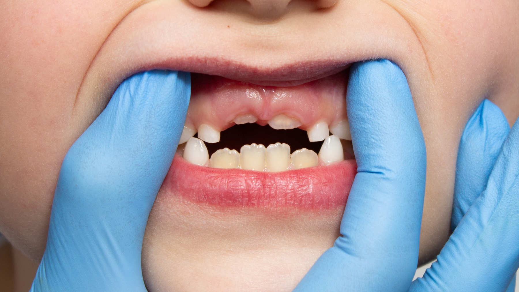 How to Prevent Fluorosis in Toddlers.