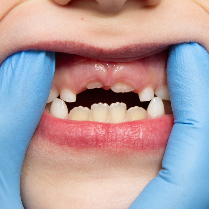 How to Prevent Fluorosis in Toddlers.