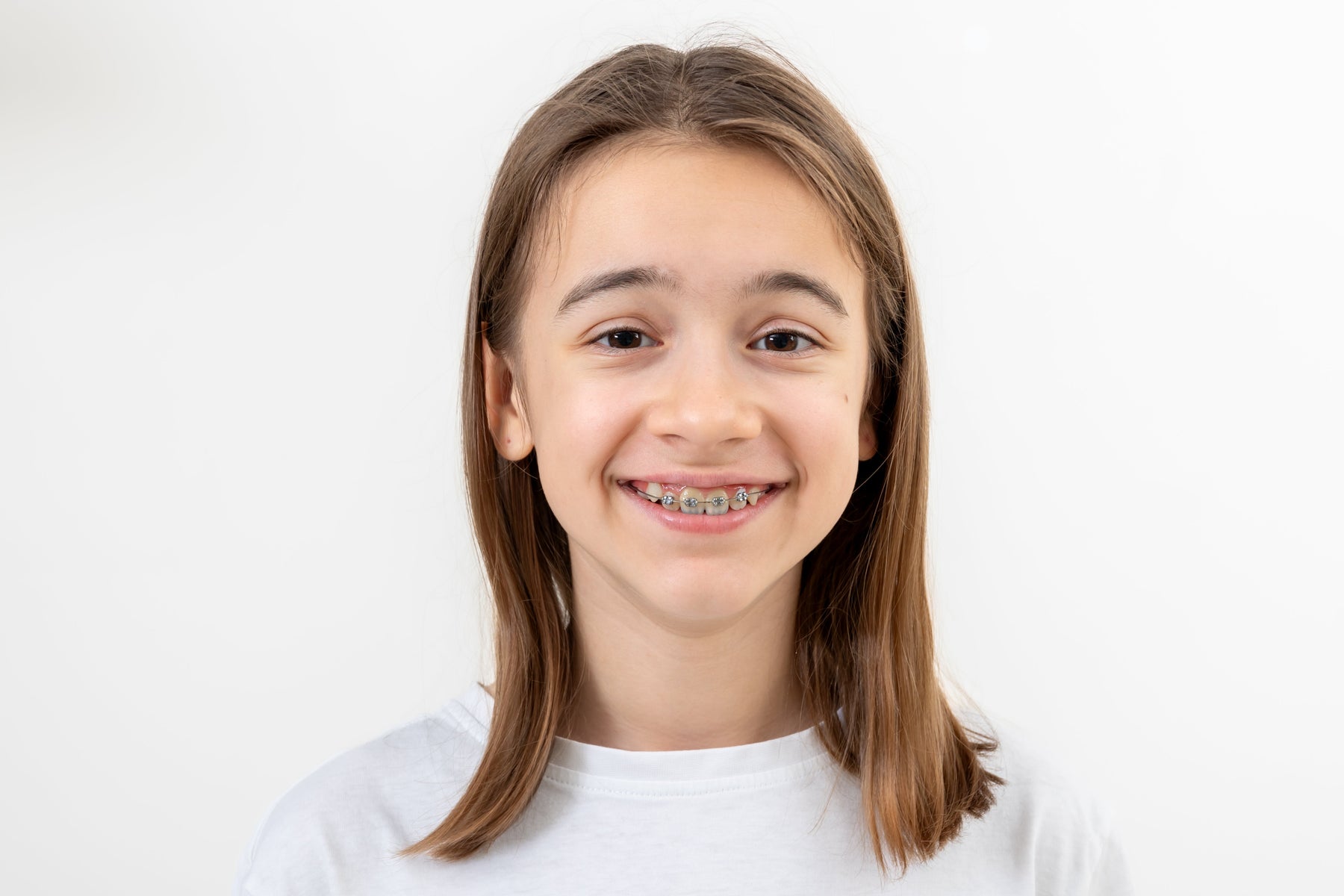 Invisalign vs Braces for Kids