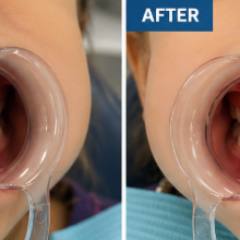 Teeth Cleaning Before and After