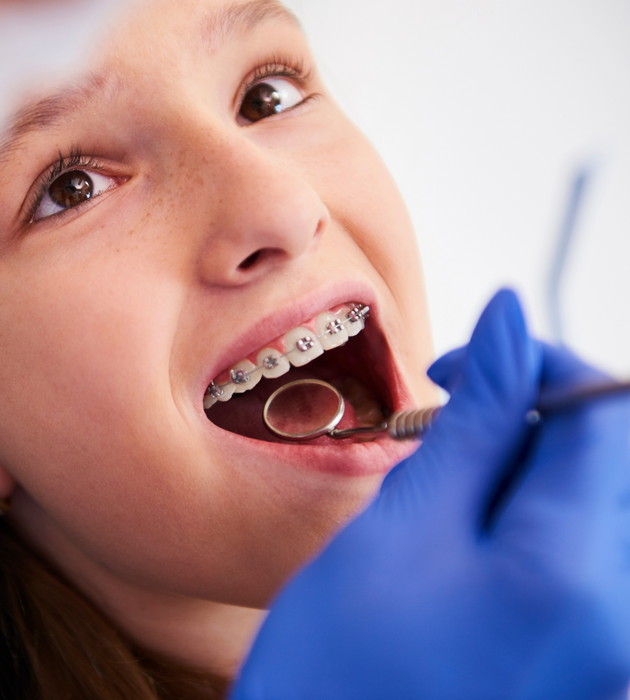 Metal Braces