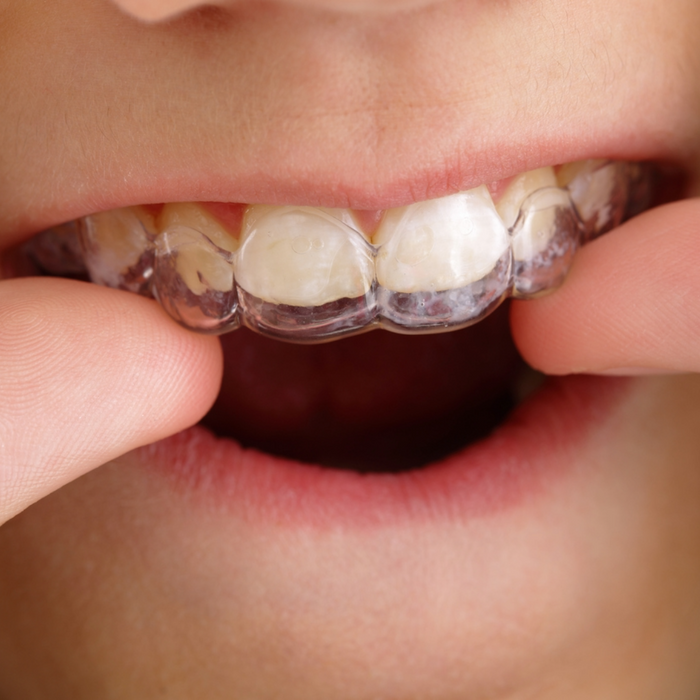 Clear Aligners