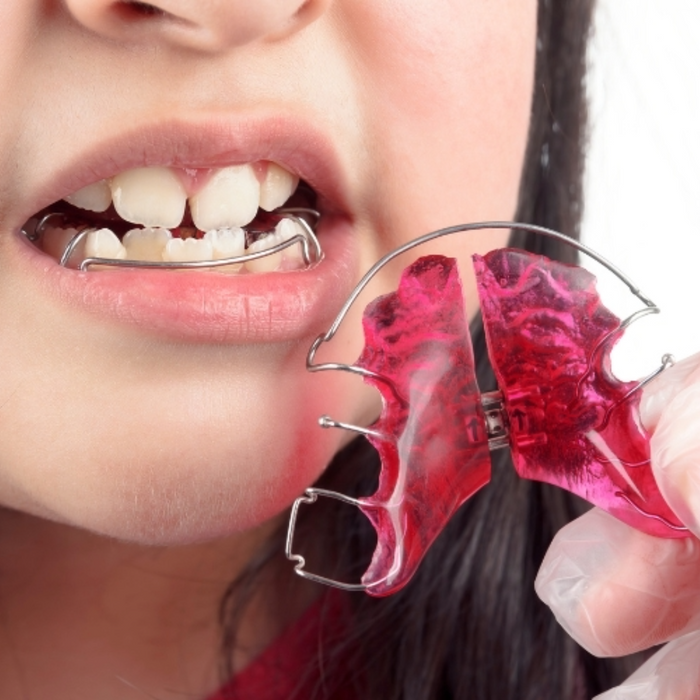 Palatal Expanders