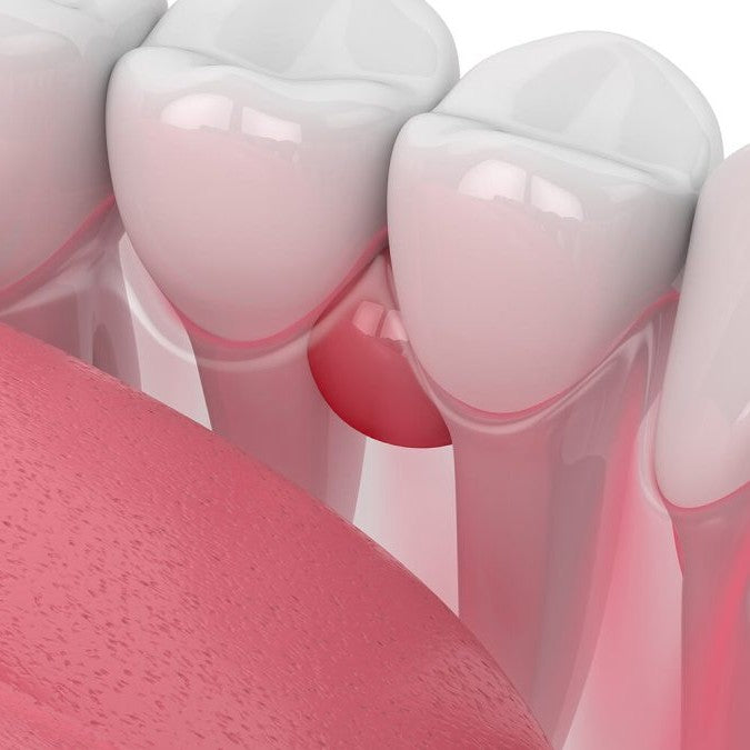 Dental Abscess Treatment