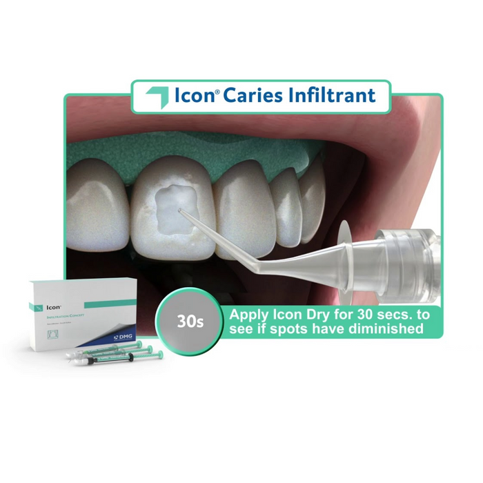 Icon Treatment for Fluorosis Stains